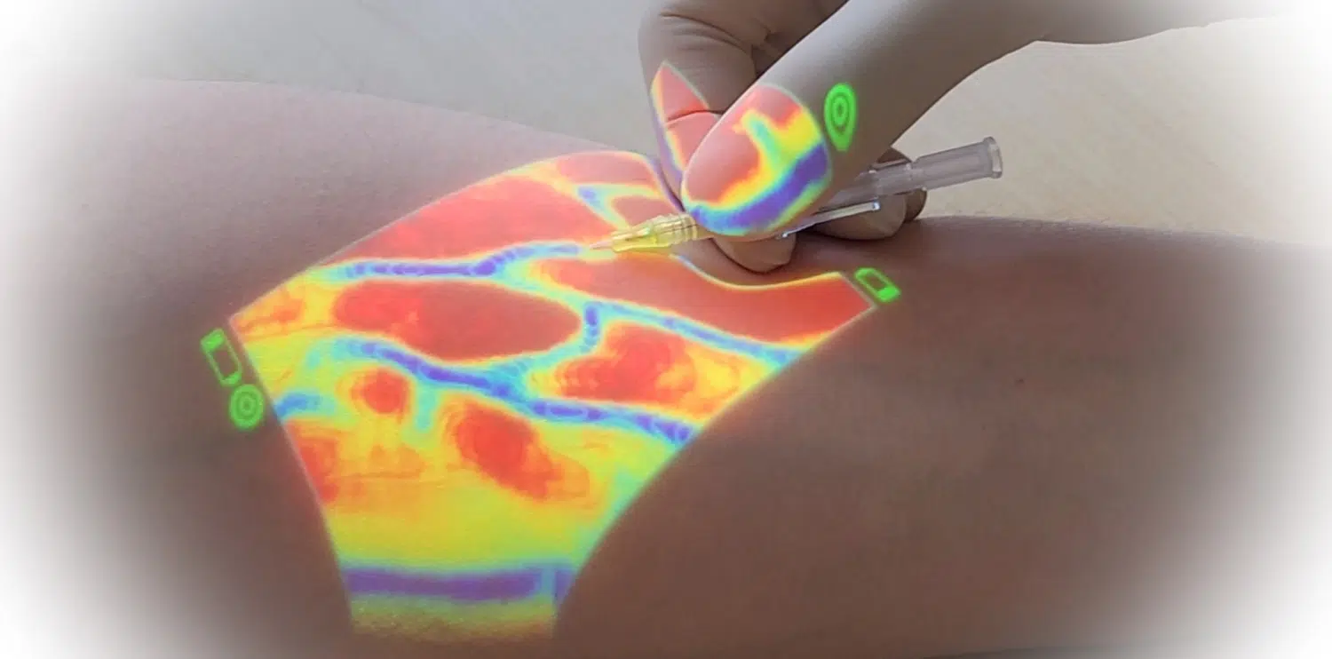 Веновізор Vein Finder у Діавіта Інститут - точний контроль та безпека процедур
